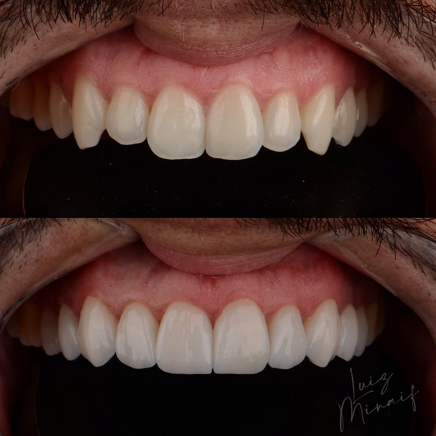 Resultado de tratamento estético, antes e depois