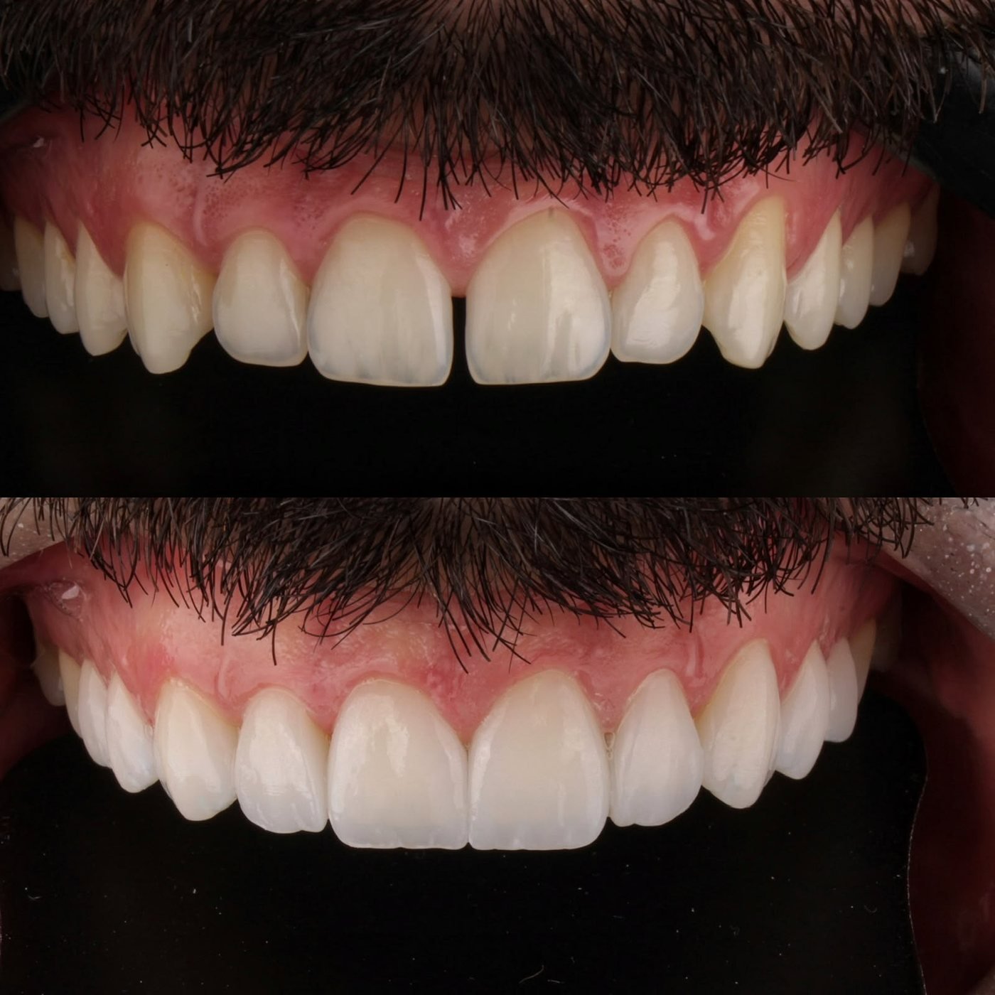 Antes e depois, reabilitação estética