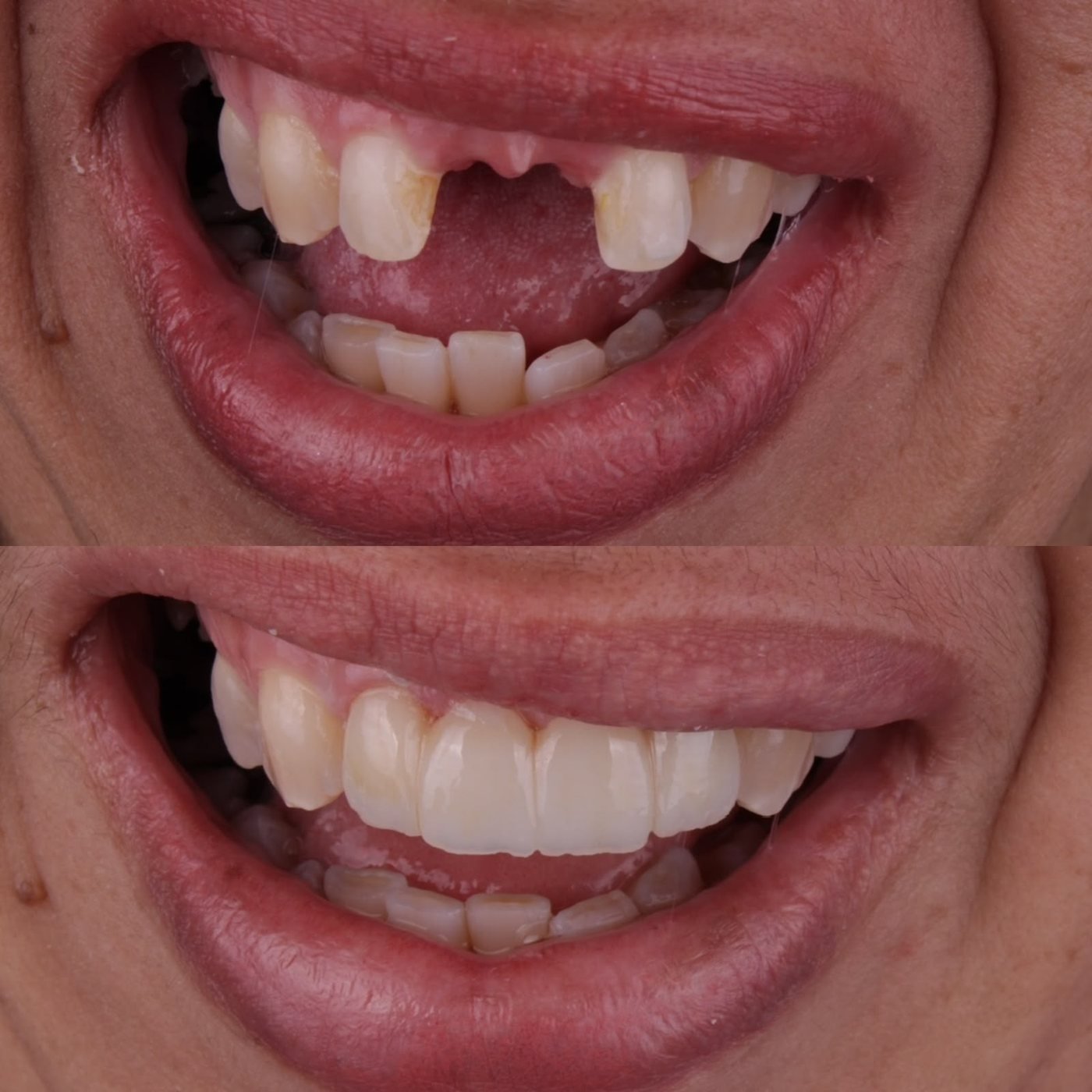 Antes e depois, fechamento de espaço dental