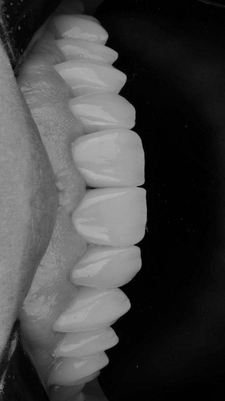 Detalhe de lentes de porcelana