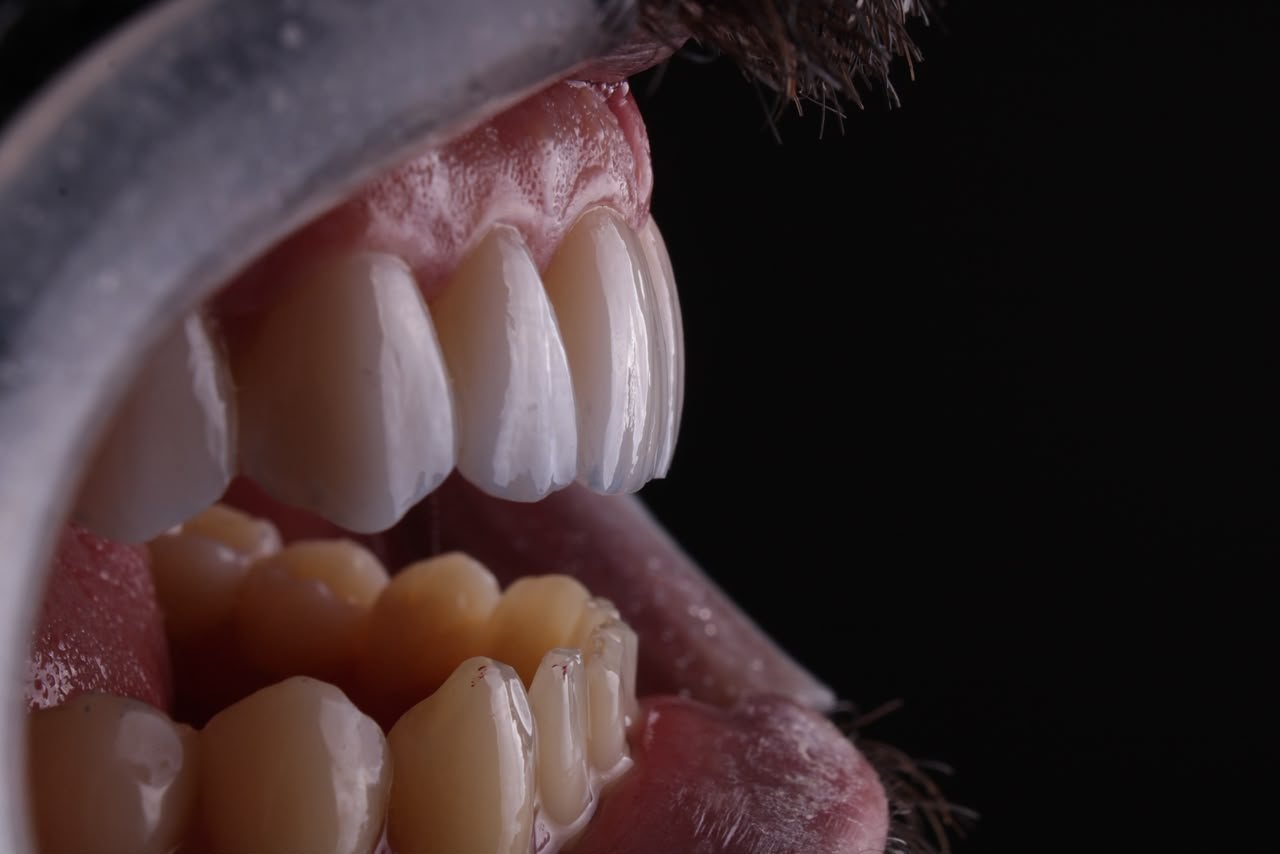 Resultado de faceta dental