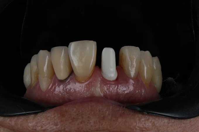 Ajuste final e resultado natural